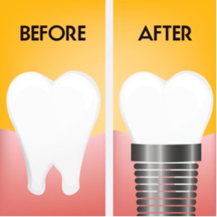 Graphic of Before & After dental implants in Lake Oswego, OR