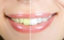 teeth whitening before and after