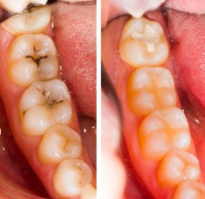 Before & After Dental Fillings in Lake Oswego, OR