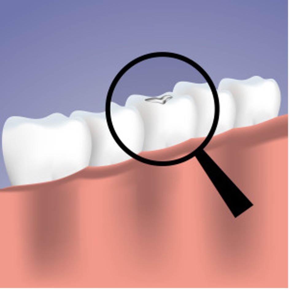 How dental fillings work in Lake Oswego, OR