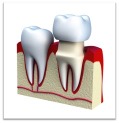 dental crowns graphic