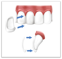 dental veneers