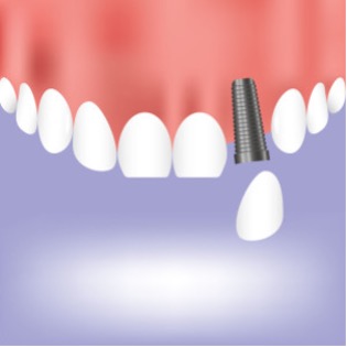 dental implants graphic