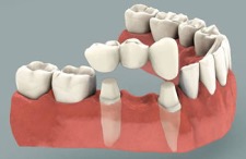 Graphic of Dental Bridges in Lake Oswego, OR