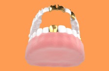 dental crowns